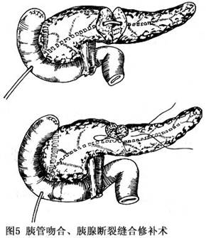 导管一端剪数个侧孔,另一端通过胆胰壶腹引入十二指肠,再经腹壁引向