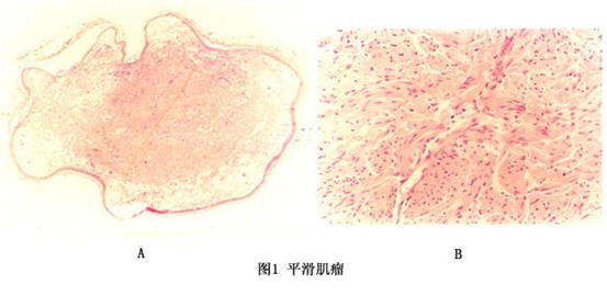 皮肤平滑肌瘤