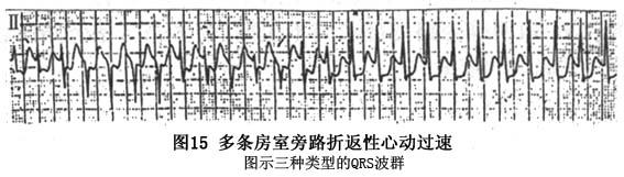 房室折返性心动过速