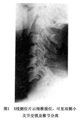 颈椎单侧及双侧小关节脱位健康百科 健客网
