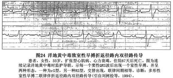 室性期前收缩