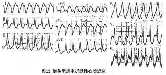 房室折返性心动过速