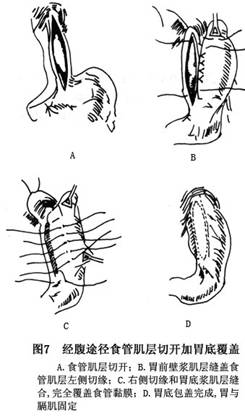 贲门失弛缓症治疗方法_如何治疗贲门失弛缓症_查疾病_疾病大全_医网