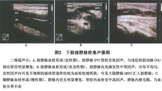 彩色多普勒超声诊断下肢深静脉血栓46例影像分析