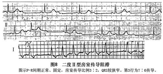 二度房室传导阻滞