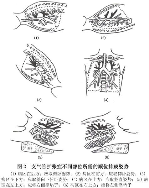 小儿支气管扩张