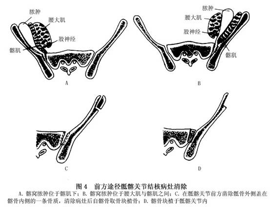 患侧下腹斜切口,自髂嵴前内斜向耻骨结节,腹膜外分离推开输尿管显出